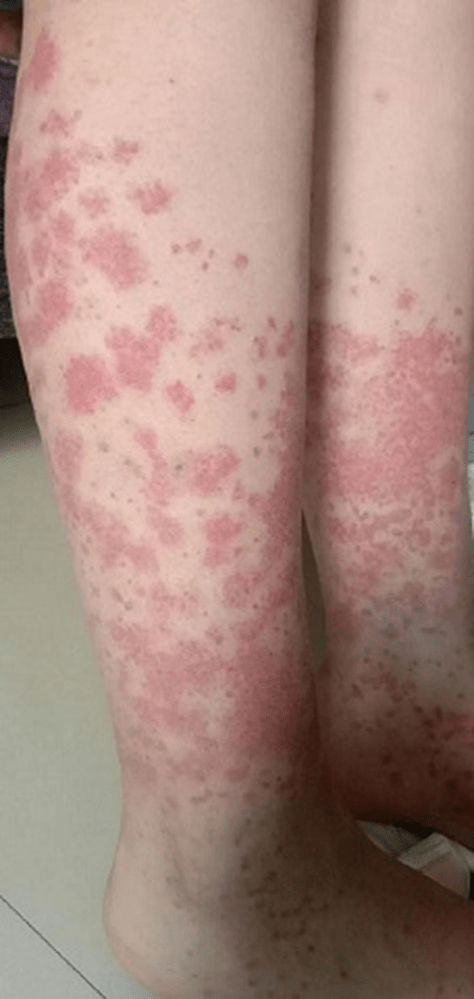 小琳的两条腿布满了对称分布的紫癜，按压后也不褪色。